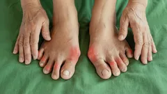 Trpíte neustálými bolestmi kloubů prstů na nohou? Odborníci vysvětlují, jak se jich navždy zbavit